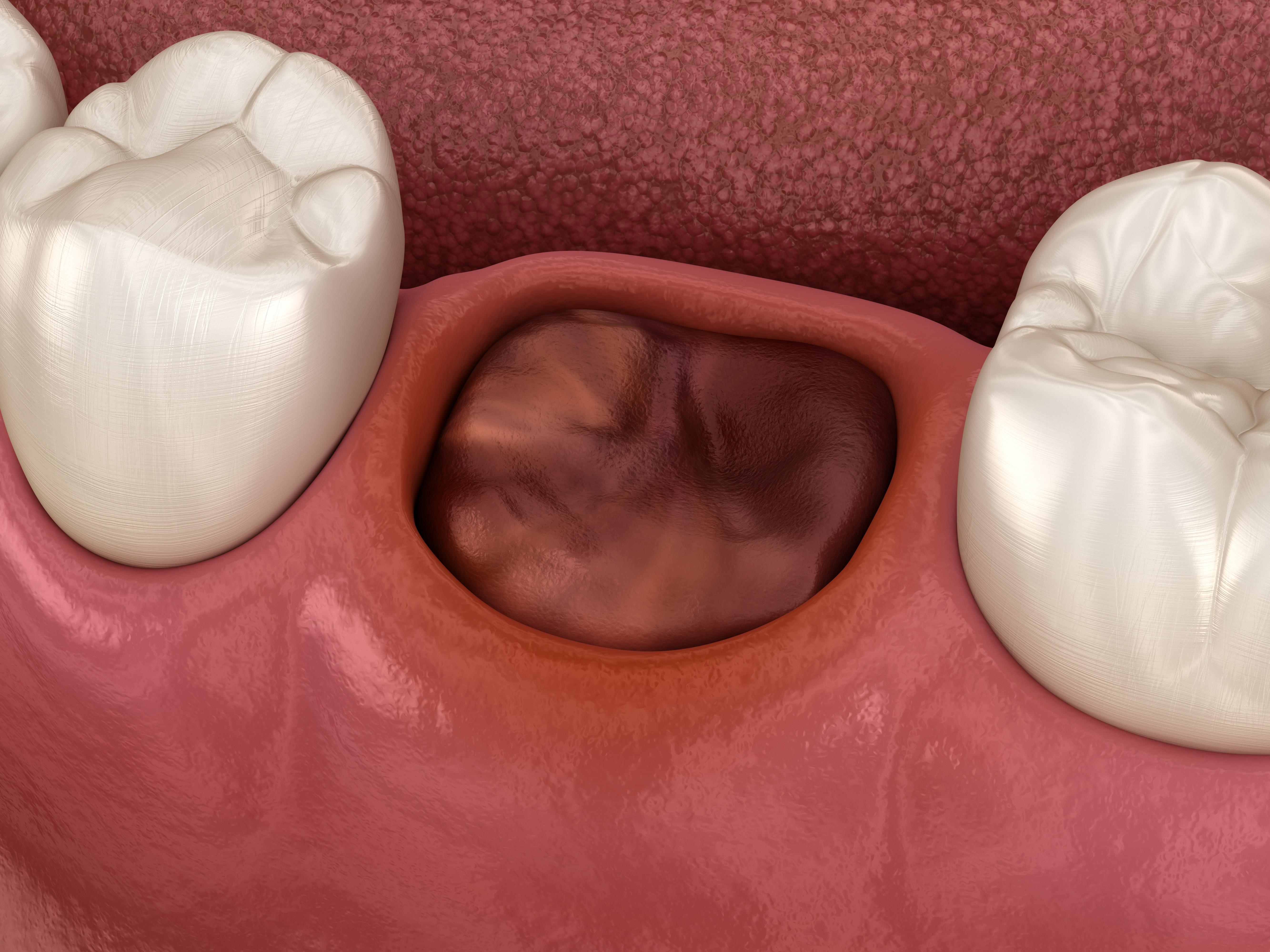 Les conseils post-opératoire après une extraction dentaire – Docteur Rindel